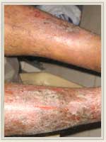 Before Treatment